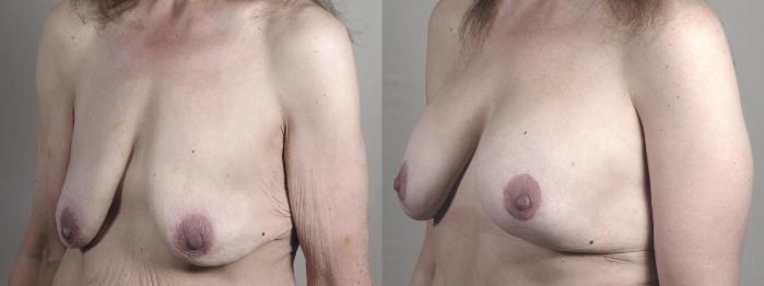 Thigh Lift Case 1304 Before & After front  | Paramus, New Jersey | Parker Center for Plastic Surgery