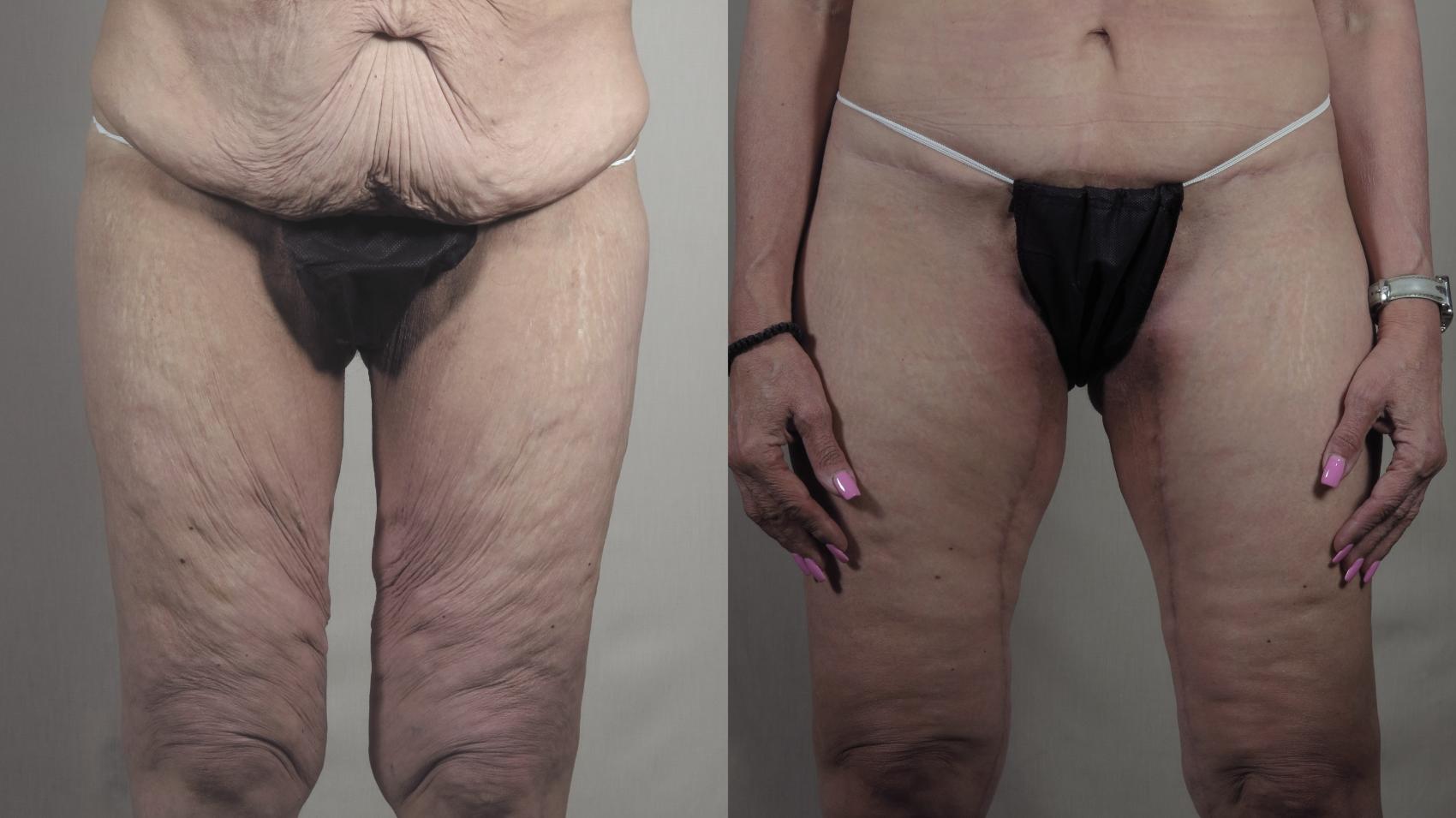 Thigh Lift Case 1304 Before & After Front | Paramus, New Jersey | Parker Center for Plastic Surgery