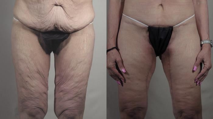 Thigh Lift Case 1304 Before & After Front | Paramus, New Jersey | Parker Center for Plastic Surgery