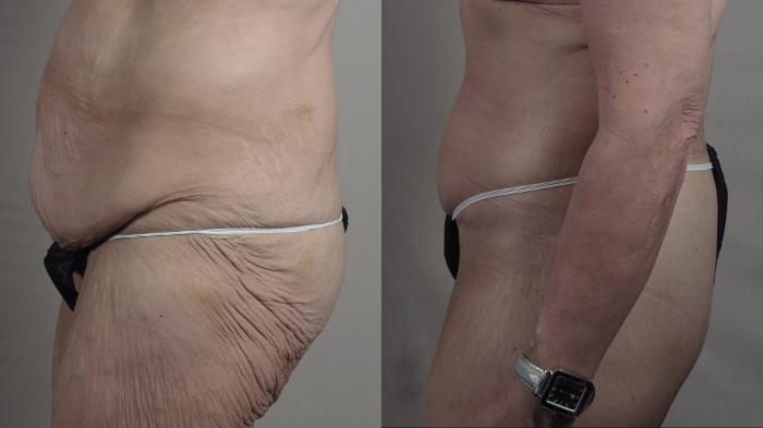 Thigh Lift Case 1304 Before & After Left Side | Paramus, New Jersey | Parker Center for Plastic Surgery