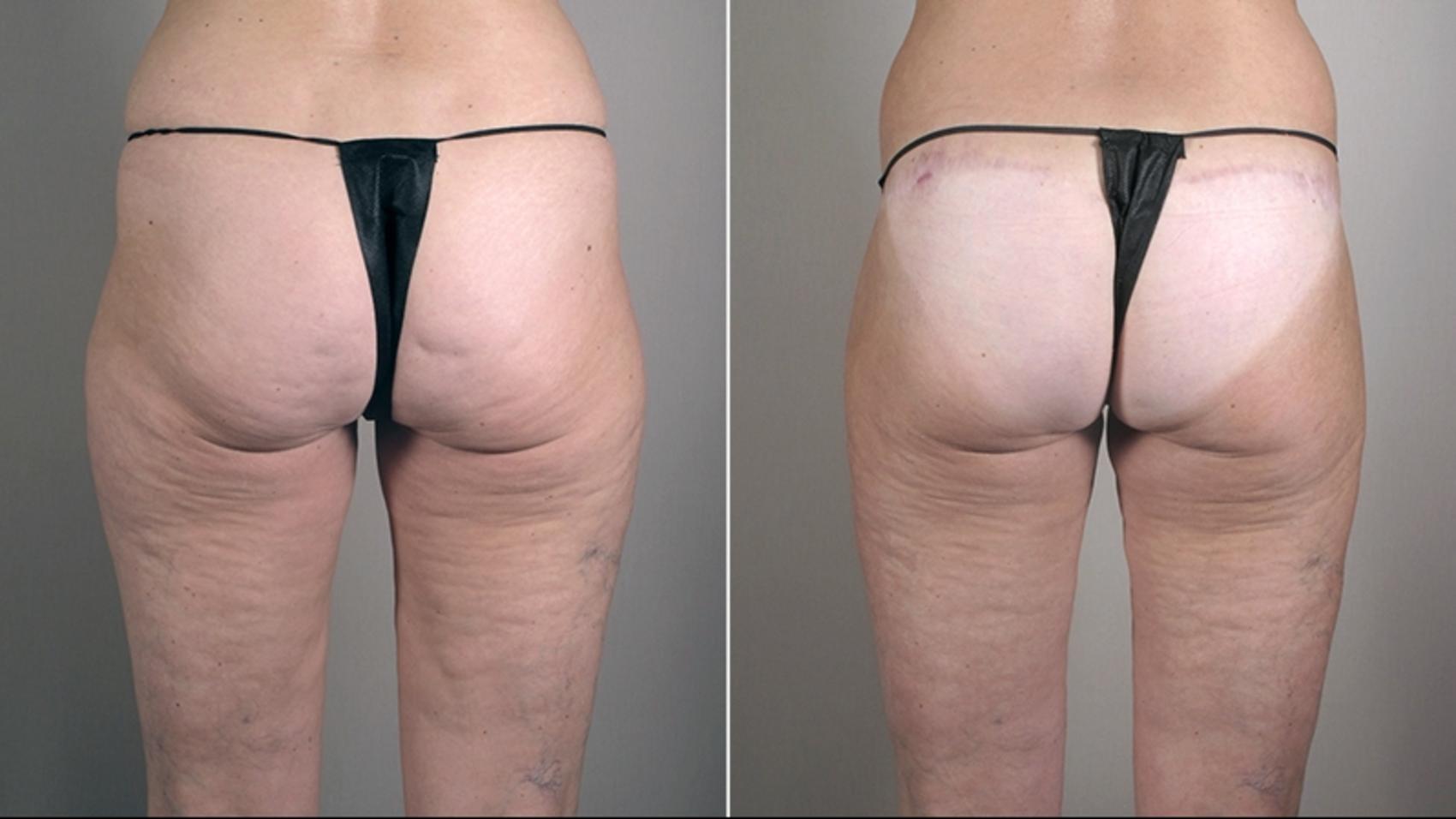 Thigh Lift Case 752 Before & After View #1 | Paramus, New Jersey | Parker Center for Plastic Surgery