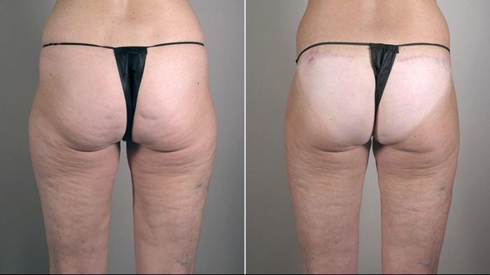 Thigh Lift Case 752 Before & After View #1 | Paramus, New Jersey | Parker Center for Plastic Surgery