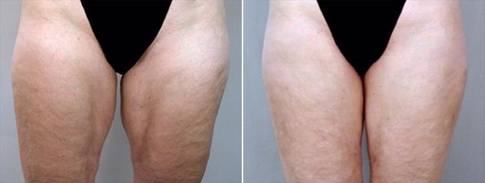 Thigh Lift Case 757 Before & After View #1 | Paramus, New Jersey | Parker Center for Plastic Surgery