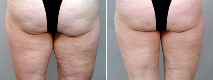 Thigh Lift Case 757 Before & After View #2 | Paramus, New Jersey | Parker Center for Plastic Surgery