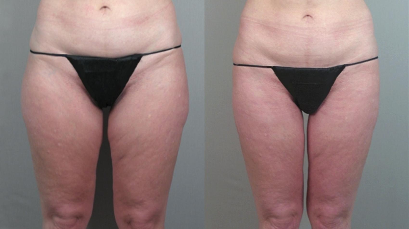 Thigh Lift Case 770 Before & After View #1 | Paramus, New Jersey | Parker Center for Plastic Surgery