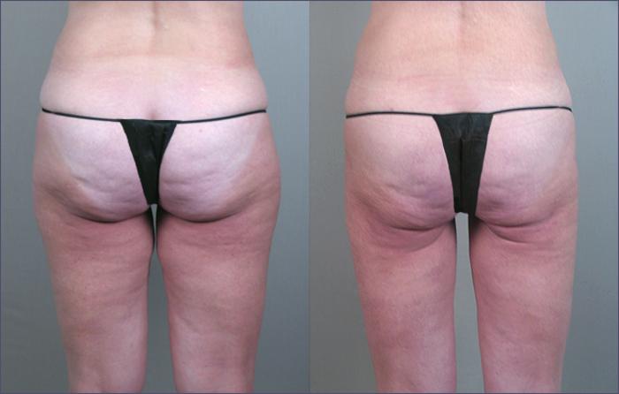 Thigh Lift Case 770 Before & After View #2 | Paramus, New Jersey | Parker Center for Plastic Surgery