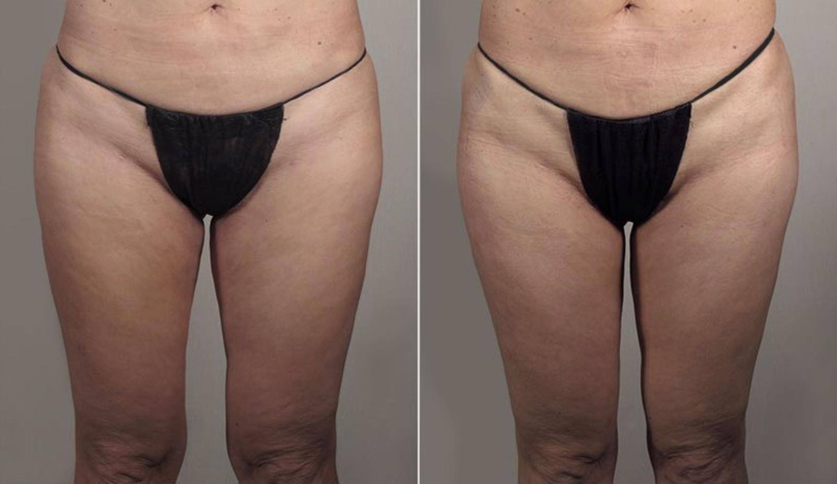 Thigh Lift Case 814 Before & After View #1 | Paramus, New Jersey | Parker Center for Plastic Surgery