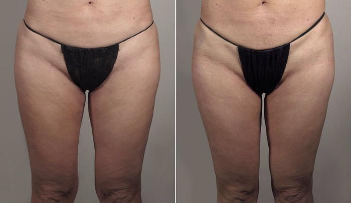 Thigh Lift Case 814 Before & After View #1 | Paramus, New Jersey | Parker Center for Plastic Surgery