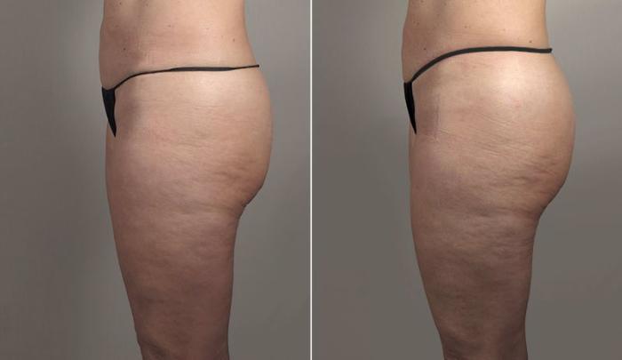 Thigh Lift Case 814 Before & After View #2 | Paramus, New Jersey | Parker Center for Plastic Surgery