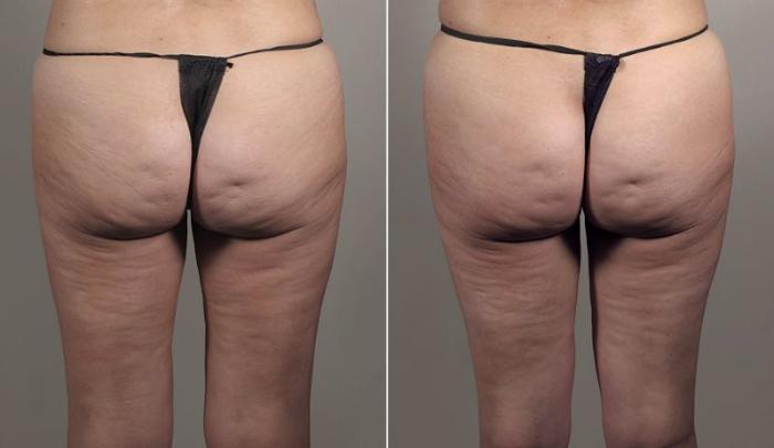 Thigh Lift Case 814 Before & After View #3 | Paramus, New Jersey | Parker Center for Plastic Surgery