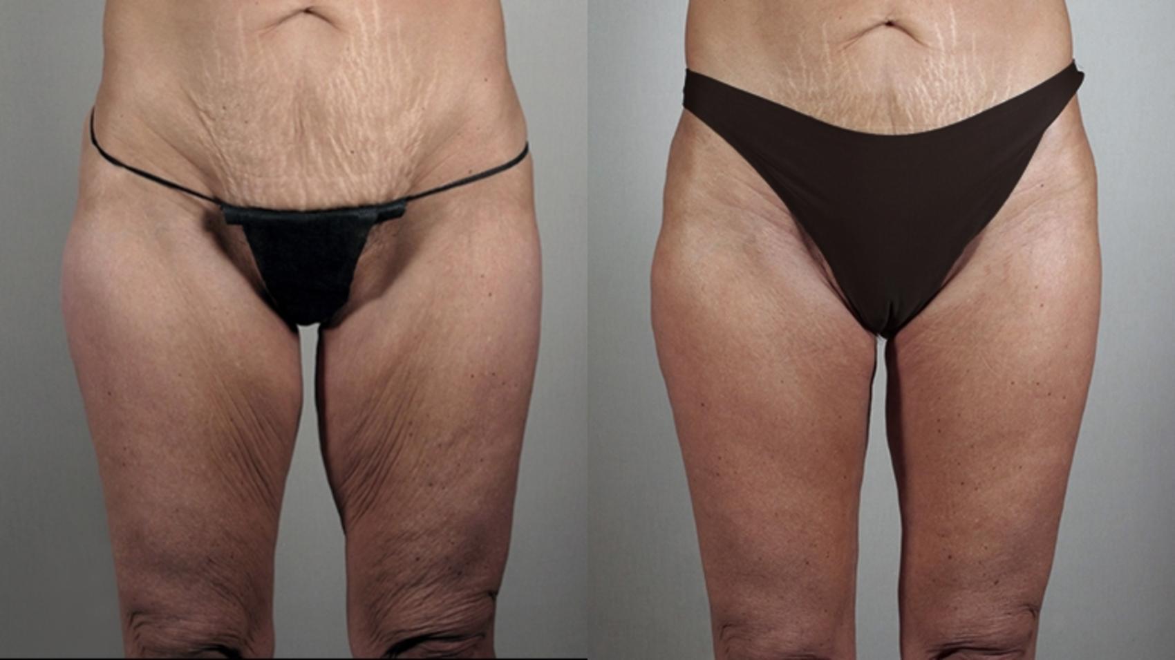 Thigh Lift Case 816 Before & After View #1 | Paramus, New Jersey | Parker Center for Plastic Surgery