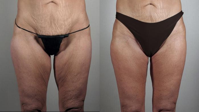 Thigh Lift Case 816 Before & After View #1 | Paramus, New Jersey | Parker Center for Plastic Surgery