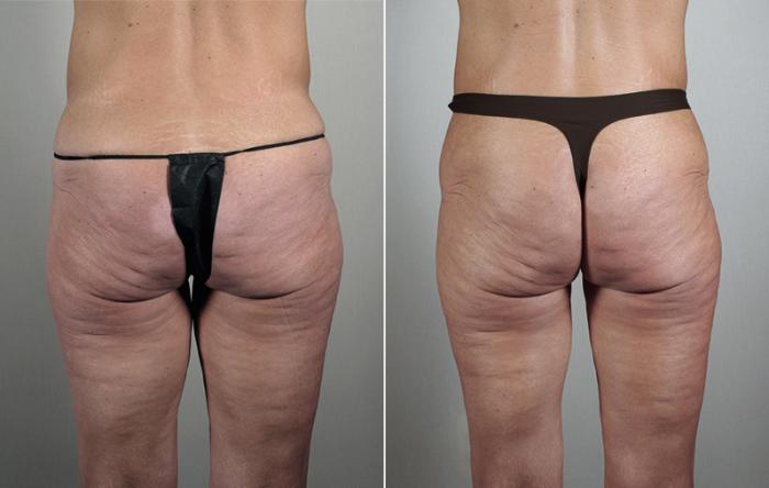 Thigh Lift Case 816 Before & After View #2 | Paramus, New Jersey | Parker Center for Plastic Surgery
