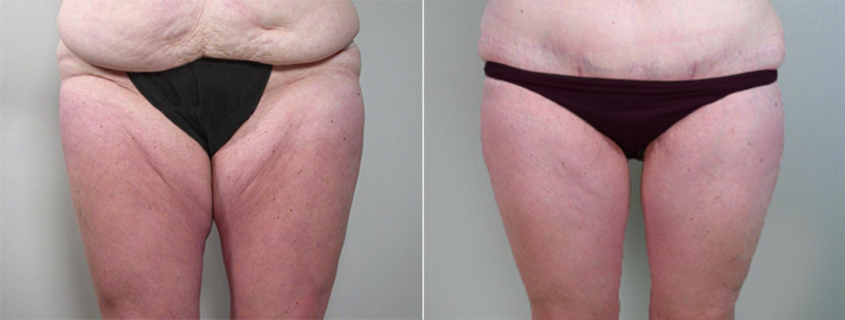 Thigh Lift Case 817 Before & After View #1 | Paramus, New Jersey | Parker Center for Plastic Surgery