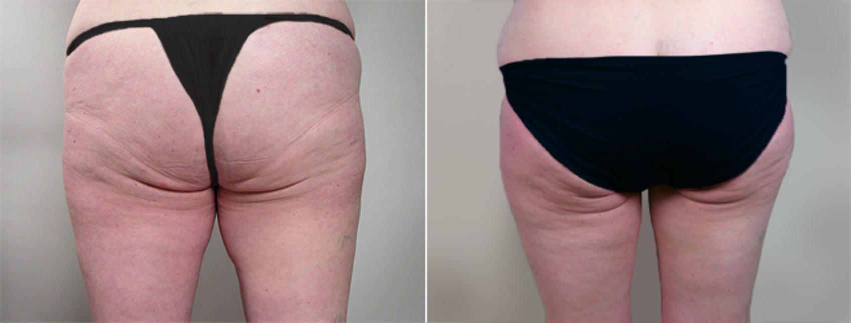 Thigh Lift Case 817 Before & After View #2 | Paramus, New Jersey | Parker Center for Plastic Surgery