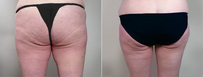 Thigh Lift Case 817 Before & After View #2 | Paramus, New Jersey | Parker Center for Plastic Surgery