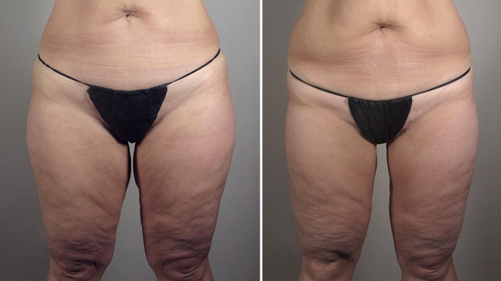 Thigh Lift Case 818 Before & After View #1 | Paramus, New Jersey | Parker Center for Plastic Surgery