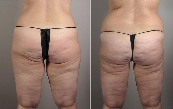 Thigh Lift Case 818 Before & After View #2 | Paramus, New Jersey | Parker Center for Plastic Surgery