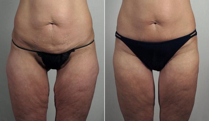 Thigh Lift Case 820 Before & After View #1 | Paramus, New Jersey | Parker Center for Plastic Surgery