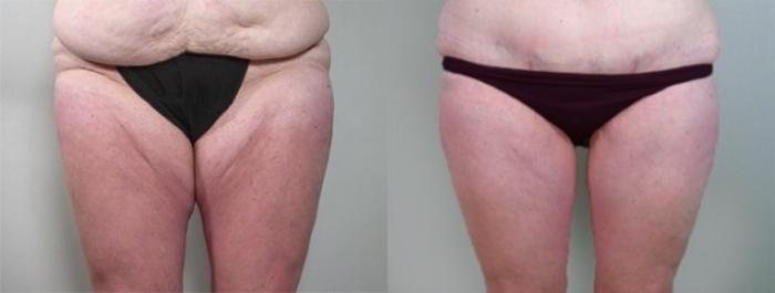 Thigh Lift Case 935 Before & After View #5 | Paramus, New Jersey | Parker Center for Plastic Surgery