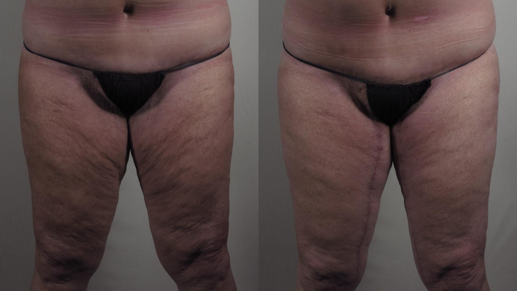 Thigh Lift Case 978 Before & After Front | Paramus, New Jersey | Parker Center for Plastic Surgery