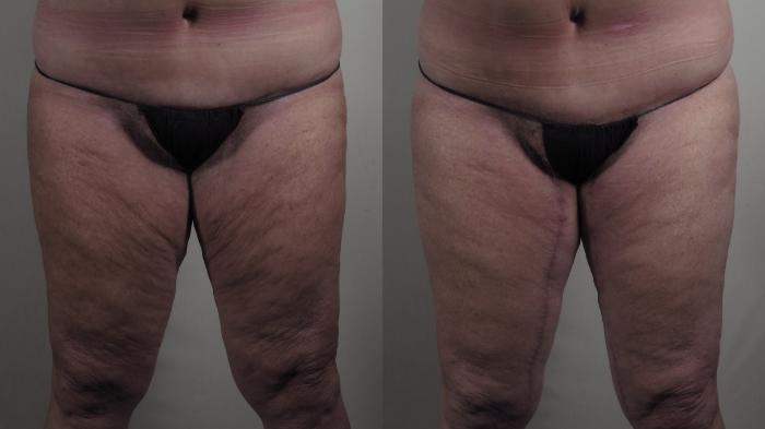 Thigh Lift Case 978 Before & After Front | Paramus, New Jersey | Parker Center for Plastic Surgery