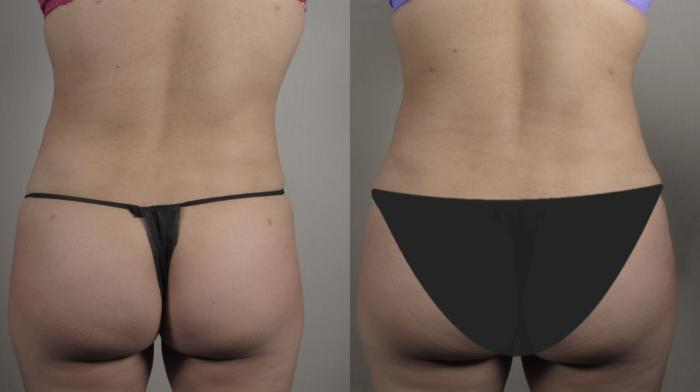Tummy Tuck Case 1006 Before & After back tt | Paramus, New Jersey | Parker Center for Plastic Surgery
