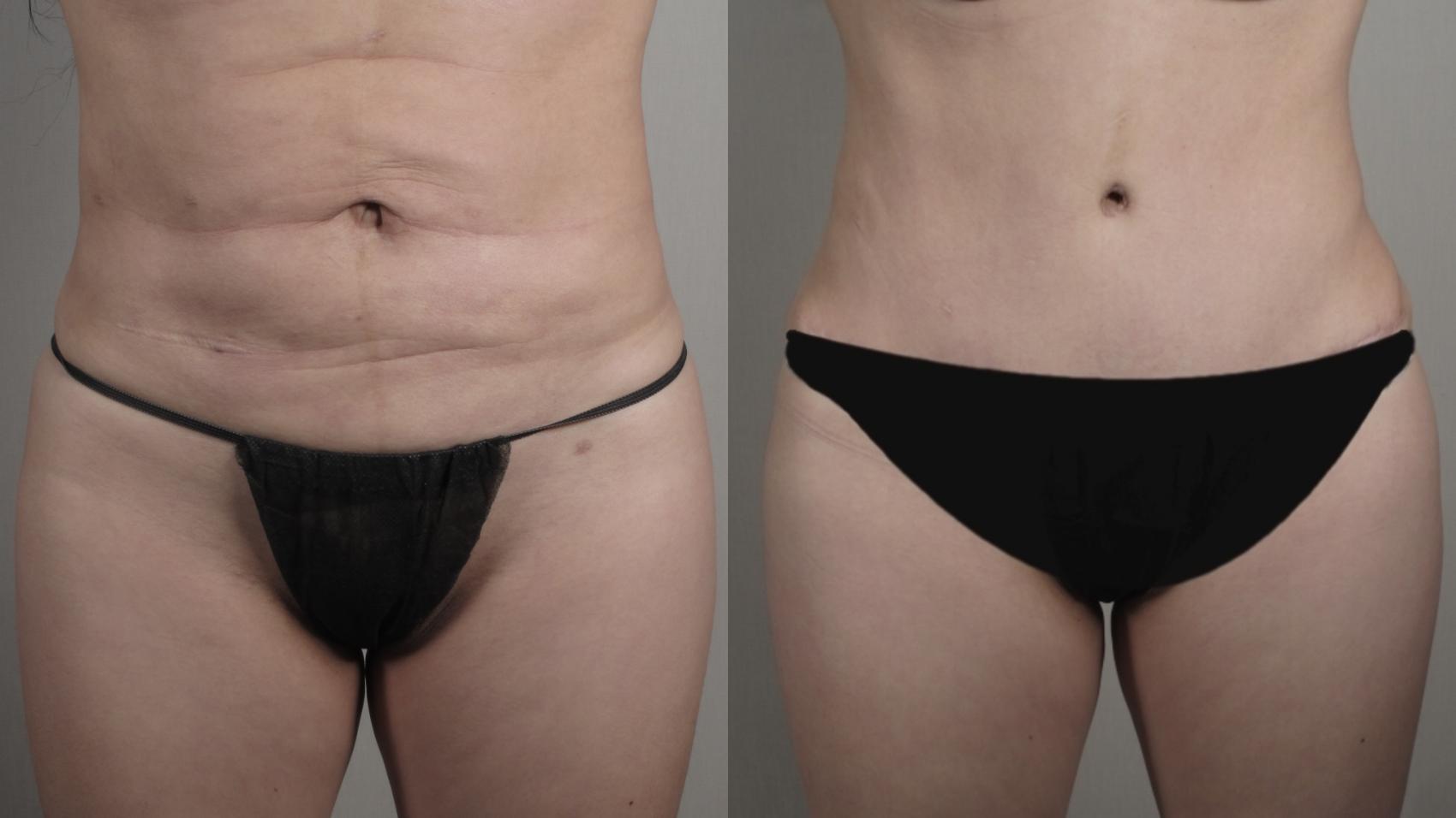 Tummy Tuck Case 1006 Before & After Front tt | Paramus, New Jersey | Parker Center for Plastic Surgery