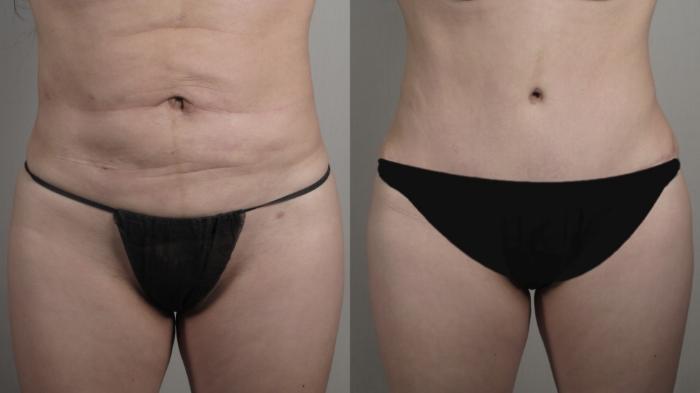 Tummy Tuck Case 1006 Before & After Front tt | Paramus, New Jersey | Parker Center for Plastic Surgery