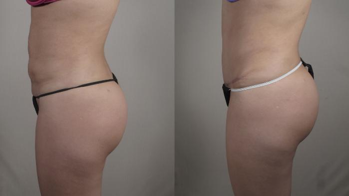 Tummy Tuck Case 1006 Before & After Right Side | Paramus, New Jersey | Parker Center for Plastic Surgery