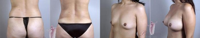 Tummy Tuck Case 1101 Before & After Back | Paramus, New Jersey | Parker Center for Plastic Surgery