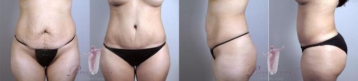 Tummy Tuck Case 1101 Before & After Front | Paramus, New Jersey | Parker Center for Plastic Surgery