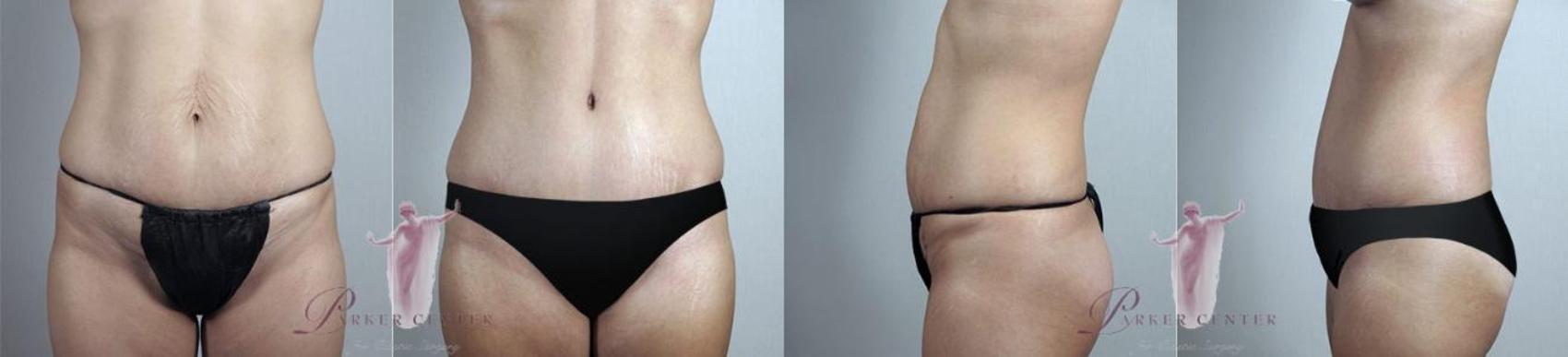 Tummy Tuck Case 1104 Before & After Front | Paramus, New Jersey | Parker Center for Plastic Surgery