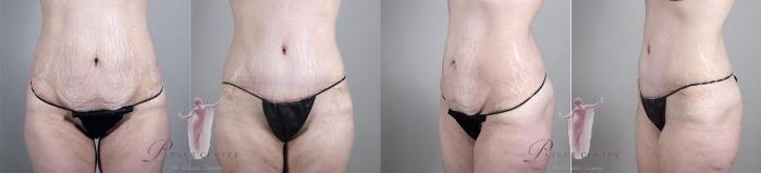Tummy Tuck Case 1105 Before & After Front | Paramus, New Jersey | Parker Center for Plastic Surgery