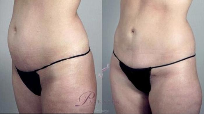 Tummy Tuck Case 1109 Before & After Left Side | Paramus, New Jersey | Parker Center for Plastic Surgery