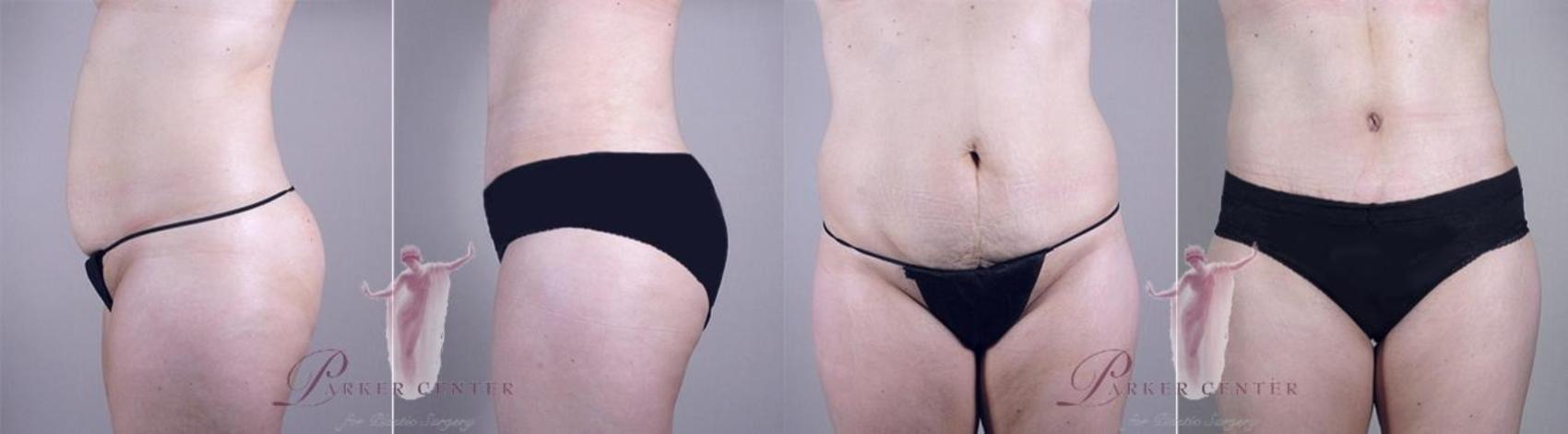 Tummy Tuck Case 1110 Before & After Front | Paramus, New Jersey | Parker Center for Plastic Surgery
