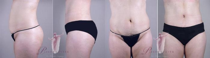 Tummy Tuck Case 1110 Before & After Front | Paramus, New Jersey | Parker Center for Plastic Surgery