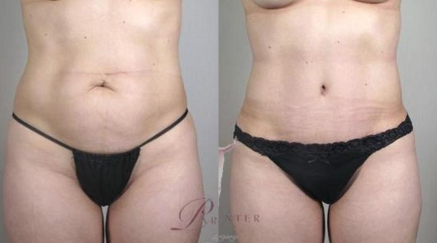 Tummy Tuck Case 1111 Before & After Front | Paramus, New Jersey | Parker Center for Plastic Surgery