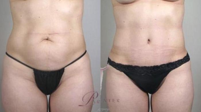 Tummy Tuck Case 1111 Before & After Front | Paramus, New Jersey | Parker Center for Plastic Surgery