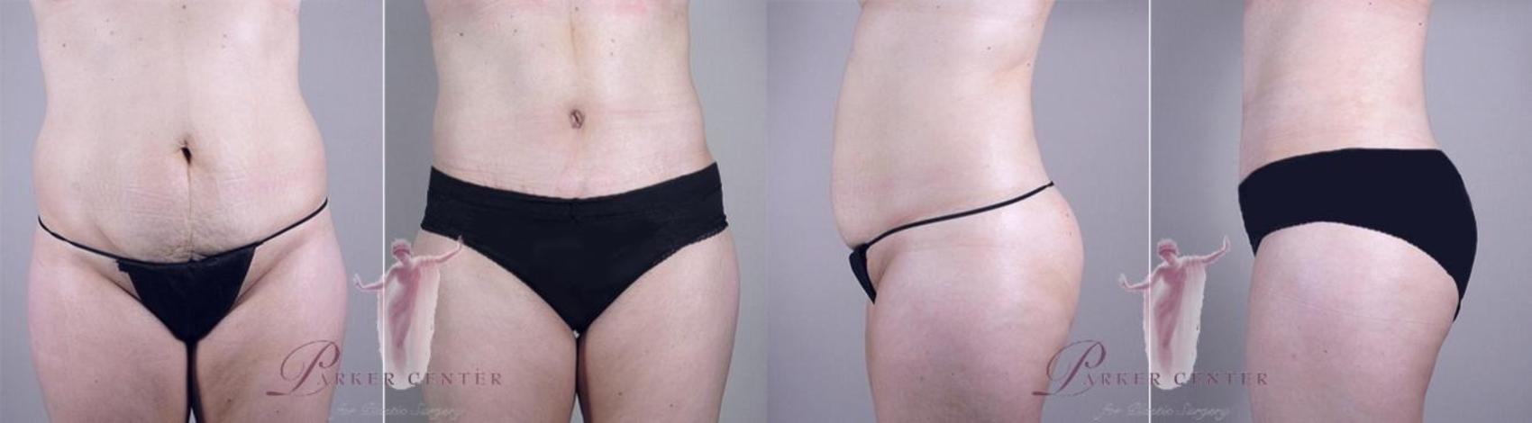 Tummy Tuck Case 1113 Before & After Front | Paramus, New Jersey | Parker Center for Plastic Surgery