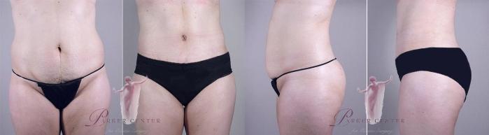 Tummy Tuck Case 1113 Before & After Front | Paramus, New Jersey | Parker Center for Plastic Surgery