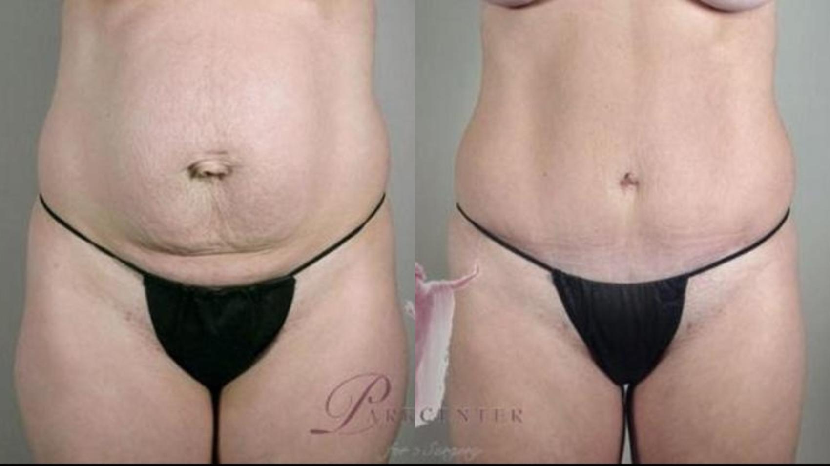 Tummy Tuck Case 1118 Before & After Front | Paramus, New Jersey | Parker Center for Plastic Surgery