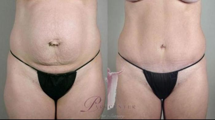 Tummy Tuck Case 1118 Before & After Front | Paramus, New Jersey | Parker Center for Plastic Surgery