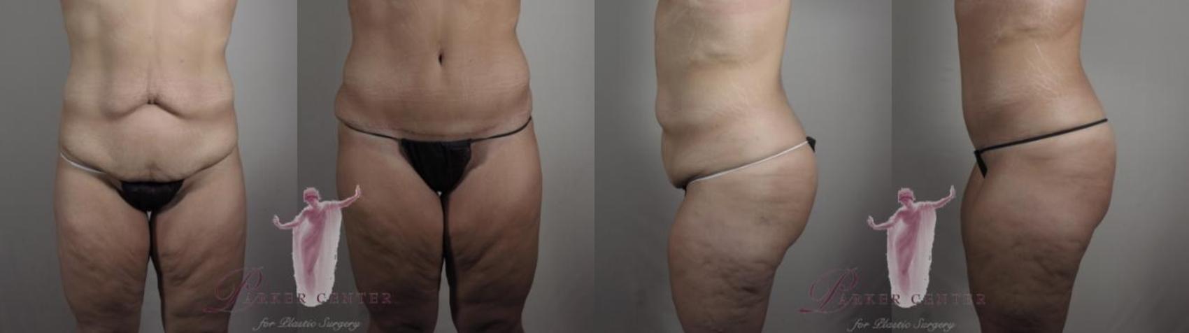 Tummy Tuck Case 1121 Before & After Front | Paramus, New Jersey | Parker Center for Plastic Surgery