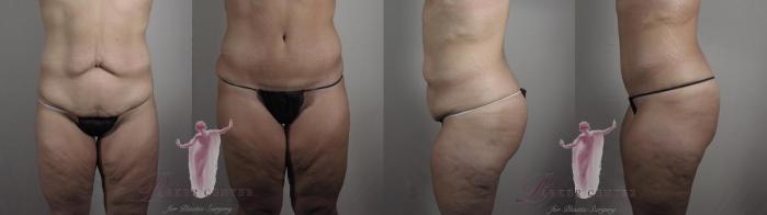 Tummy Tuck Case 1121 Before & After Front | Paramus, New Jersey | Parker Center for Plastic Surgery