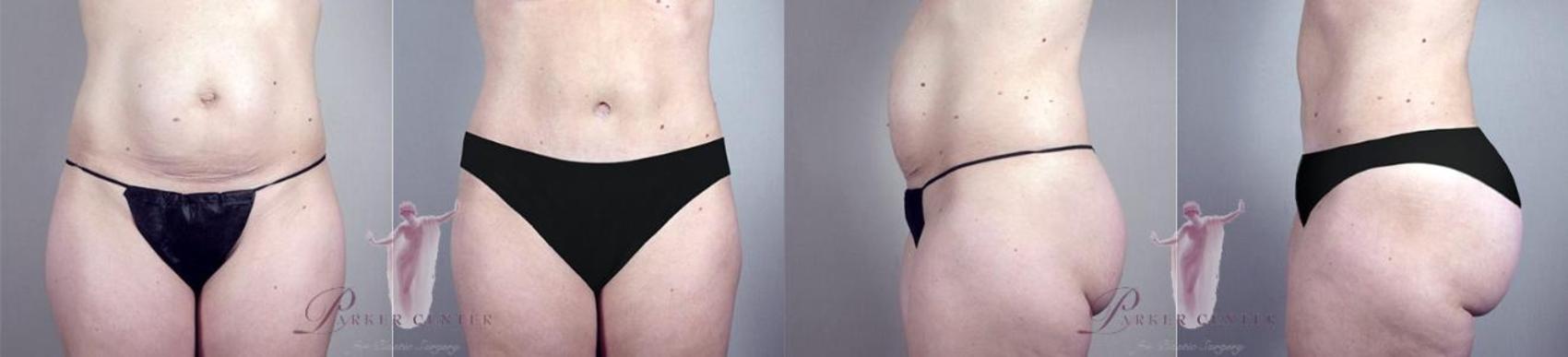 Tummy Tuck Case 1122 Before & After Front | Paramus, New Jersey | Parker Center for Plastic Surgery