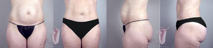 Tummy Tuck Case 1122 Before & After Front | Paramus, New Jersey | Parker Center for Plastic Surgery