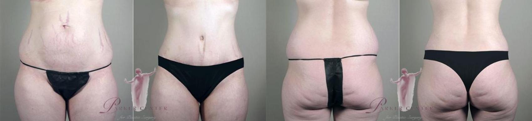 Tummy Tuck Case 1124 Before & After Front | Paramus, New Jersey | Parker Center for Plastic Surgery