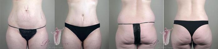Tummy Tuck Case 1124 Before & After Front | Paramus, New Jersey | Parker Center for Plastic Surgery