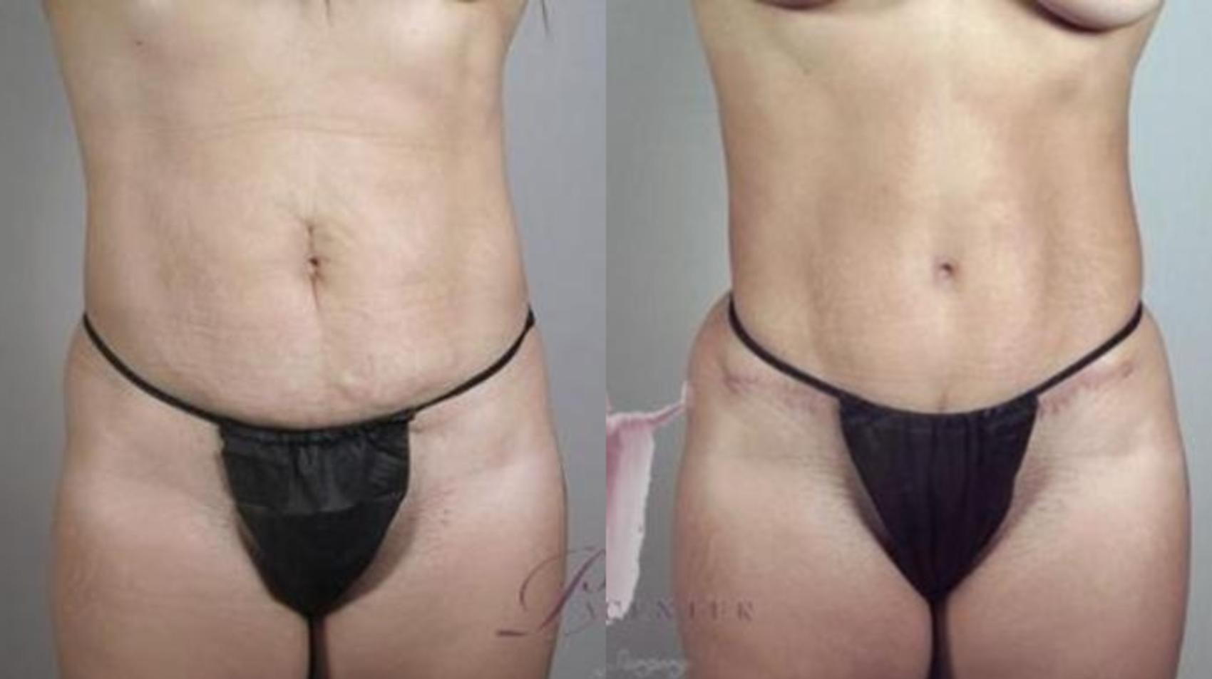Tummy Tuck Case 1130 Before & After Front | Paramus, New Jersey | Parker Center for Plastic Surgery